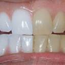 Clareamento dental natural sem produtos químicos