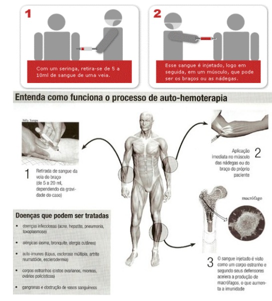 Auto hemoterapia como funciona