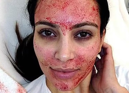 Vampire face procedimento