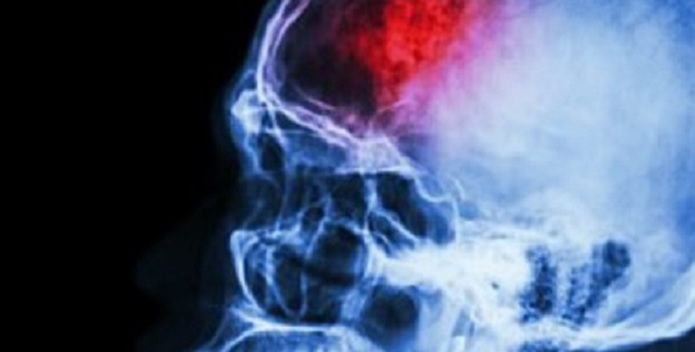 Lesão Axonal Difusa: Uma Visão Abrangente