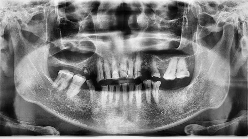 Remédio radioativo dentição