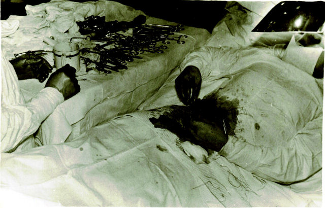Rogozov cirurgia