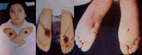 Estigmas pes