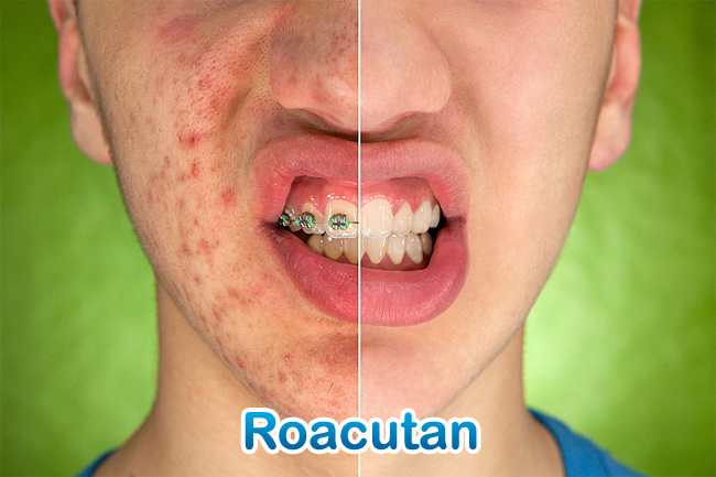 roacutan 2