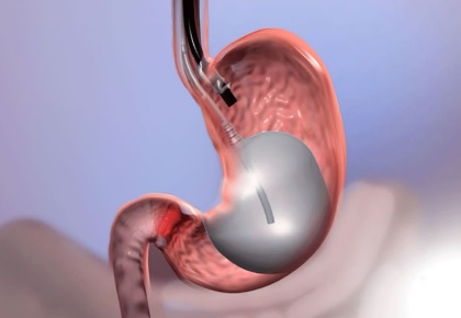gastribalao2