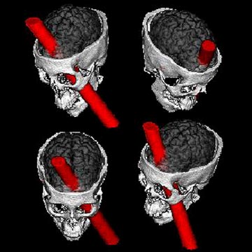 7_Phineas_Gage_2