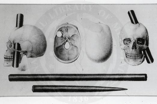 7_phineas_gage_3