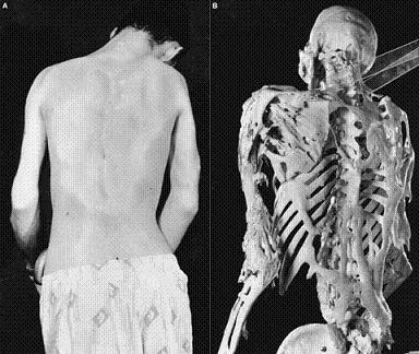 fibrodisplasia
