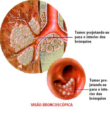 bronquios