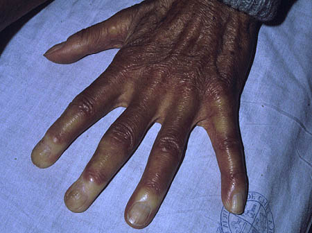 raynaud1