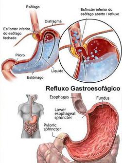 refluxo5