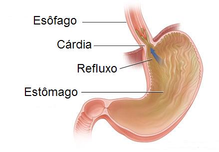 refluxo6