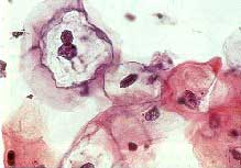 hpv_2