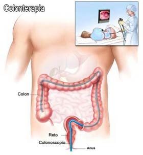 Hidrocolon esquema