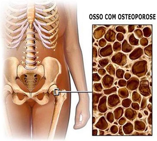 Osteopatia ossos